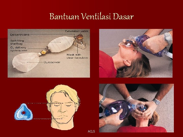 Bantuan Ventilasi Dasar ACLS 