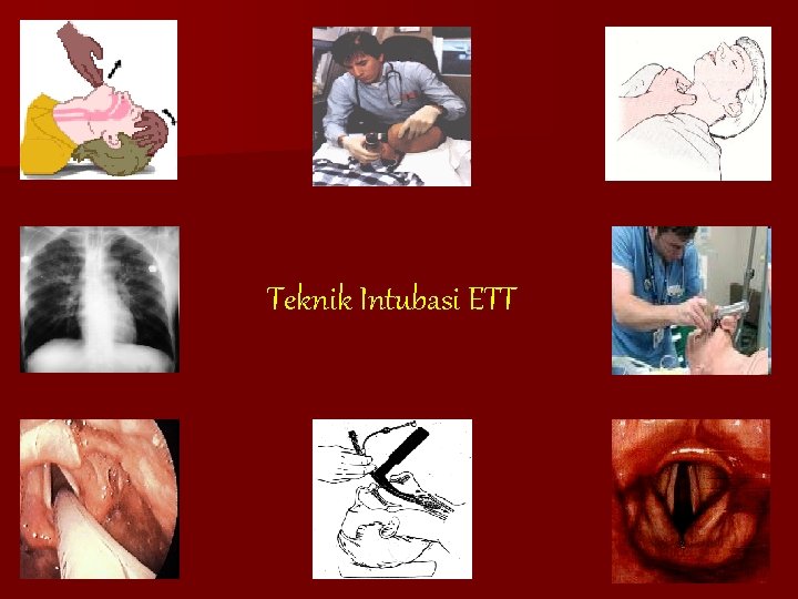 Teknik Intubasi ETT ACLS 