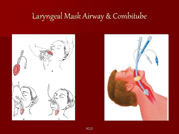 Laryngeal Mask Airway & Combitube ACLS 