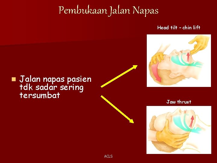 Pembukaan Jalan Napas Head tilt – chin lift n Jalan napas pasien tdk sadar