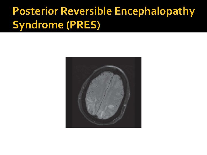 Posterior Reversible Encephalopathy Syndrome (PRES) 