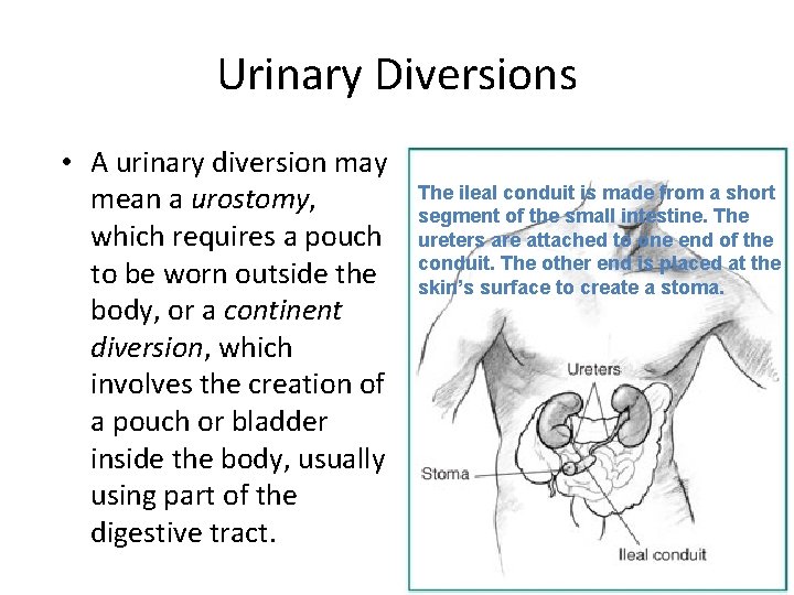 Urinary Diversions • A urinary diversion may mean a urostomy, which requires a pouch