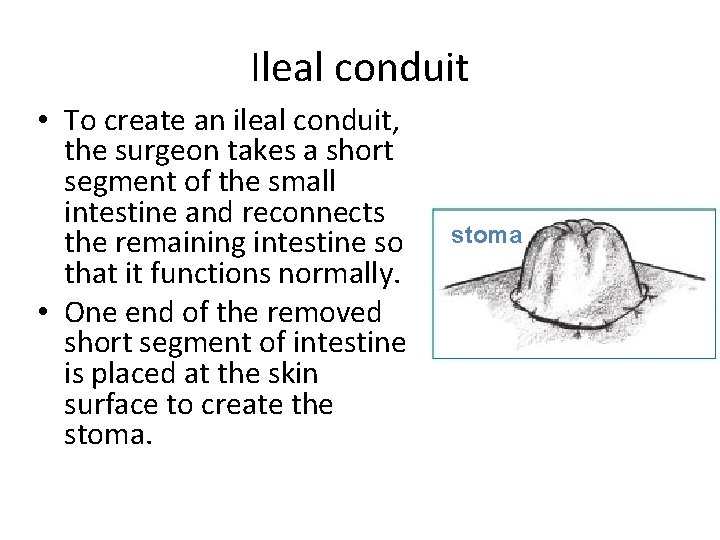 Ileal conduit • To create an ileal conduit, the surgeon takes a short segment