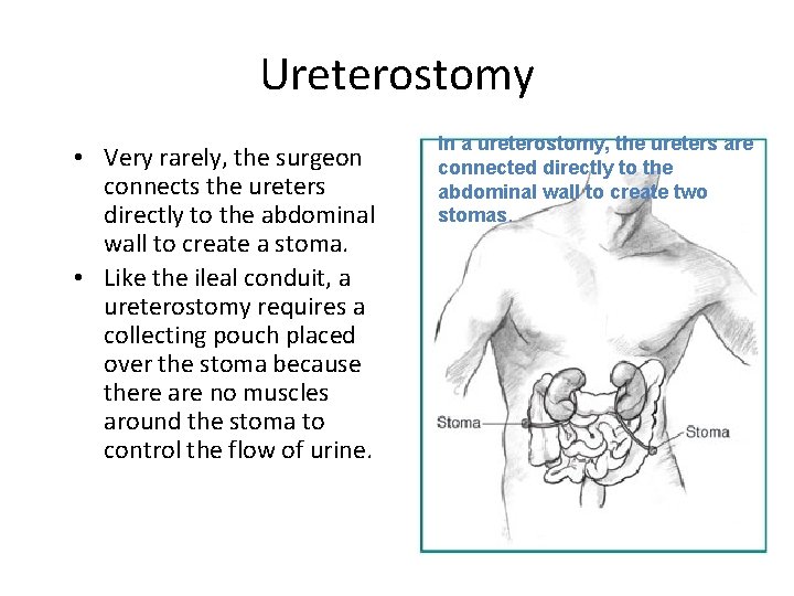 Ureterostomy • Very rarely, the surgeon connects the ureters directly to the abdominal wall