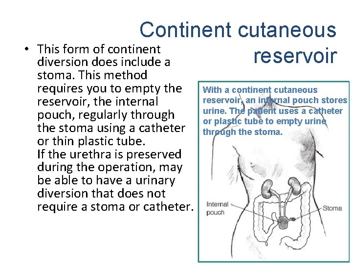 • Continent cutaneous This form of continent reservoir diversion does include a stoma.