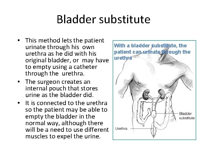 Bladder substitute • This method lets the patient urinate through his own urethra as