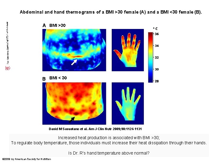 Abdominal and hand thermograms of a BMI >30 female (A) and a BMI <30