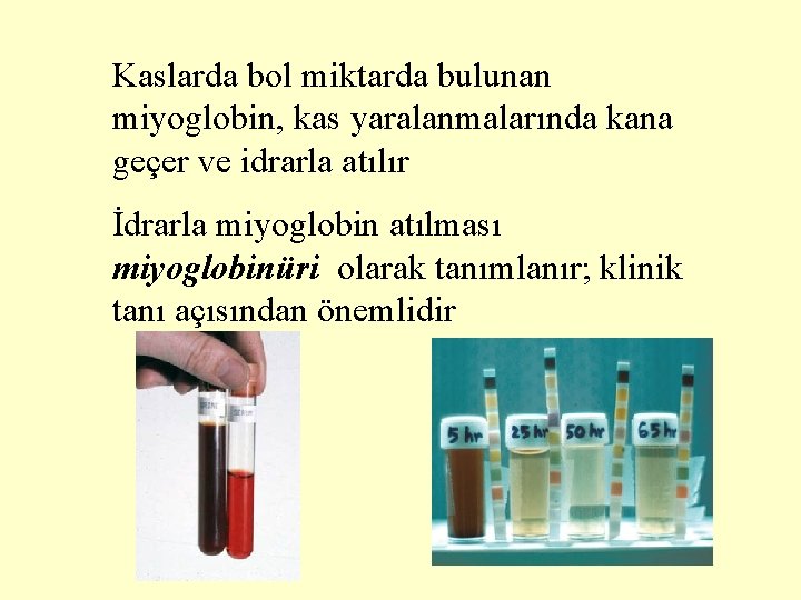 Kaslarda bol miktarda bulunan miyoglobin, kas yaralanmalarında kana geçer ve idrarla atılır İdrarla miyoglobin