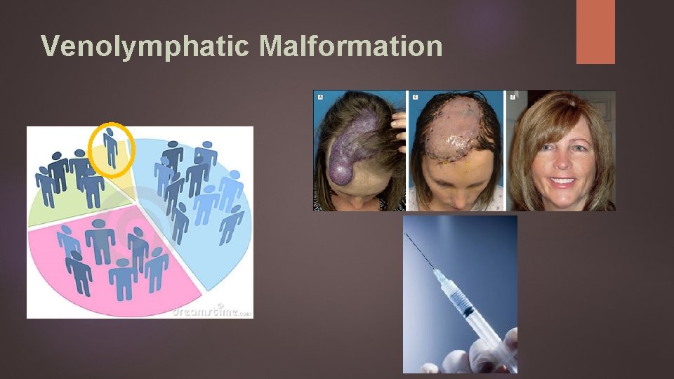Venolymphatic Malformation 