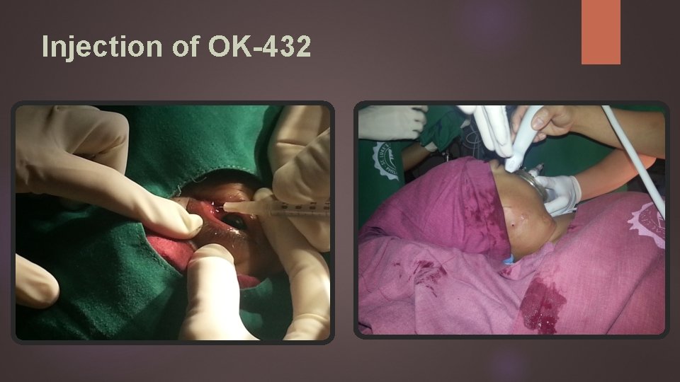 Injection of OK-432 