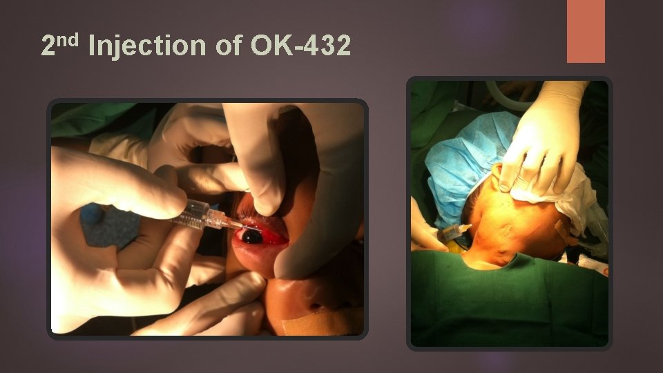 nd 2 Injection of OK-432 