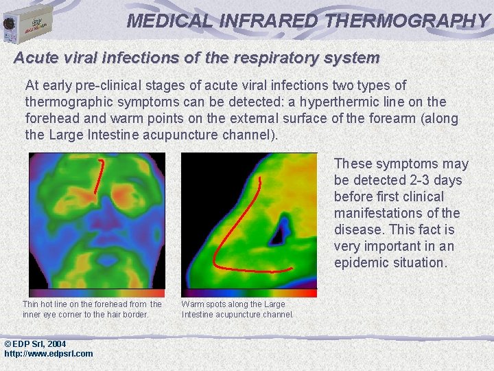 MEDICAL INFRARED THERMOGRAPHY Acute viral infections of the respiratory system At early pre-clinical stages