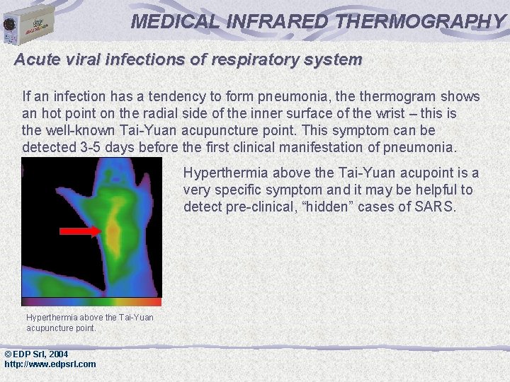MEDICAL INFRARED THERMOGRAPHY Acute viral infections of respiratory system If an infection has a