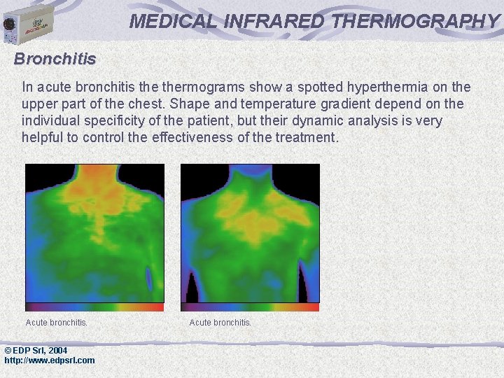 MEDICAL INFRARED THERMOGRAPHY Bronchitis In acute bronchitis thermograms show a spotted hyperthermia on the