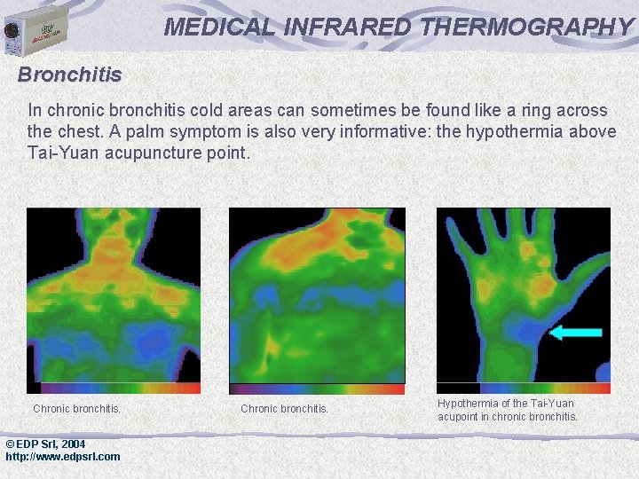 MEDICAL INFRARED THERMOGRAPHY Bronchitis In chronic bronchitis cold areas can sometimes be found like