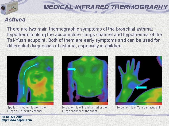 MEDICAL INFRARED THERMOGRAPHY Asthma There are two main thermographic symptoms of the bronchial asthma: