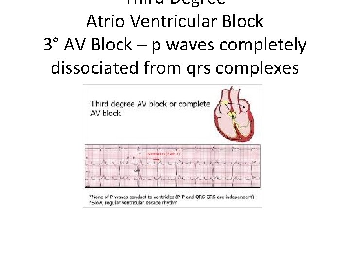 Third Degree Atrio Ventricular Block 3° AV Block – p waves completely dissociated from