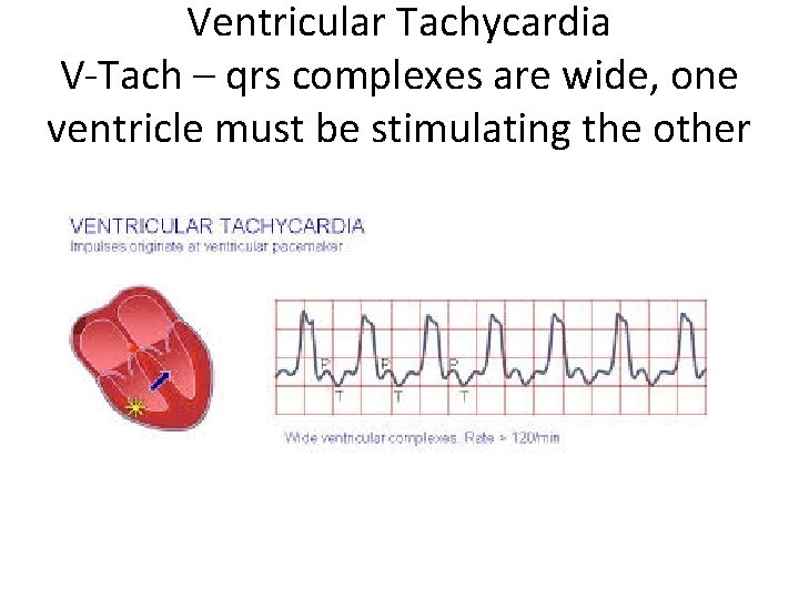 Ventricular Tachycardia V-Tach – qrs complexes are wide, one ventricle must be stimulating the