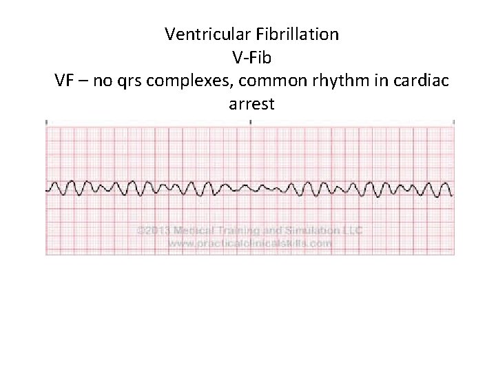 Ventricular Fibrillation V-Fib VF – no qrs complexes, common rhythm in cardiac arrest 