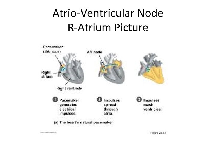 Atrio-Ventricular Node R-Atrium Picture 