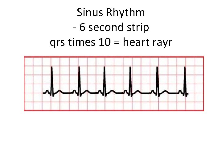 Sinus Rhythm - 6 second strip qrs times 10 = heart rayr 