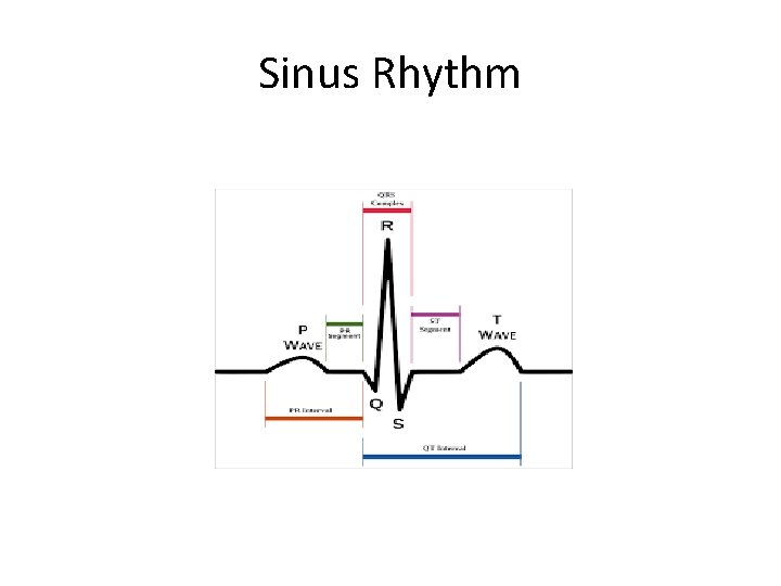 Sinus Rhythm 