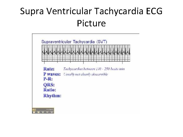 Supra Ventricular Tachycardia ECG Picture 
