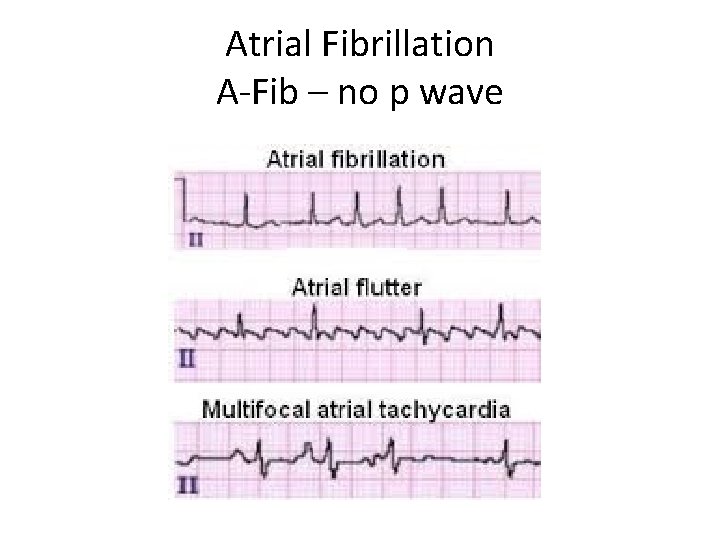 Atrial Fibrillation A-Fib – no p wave 