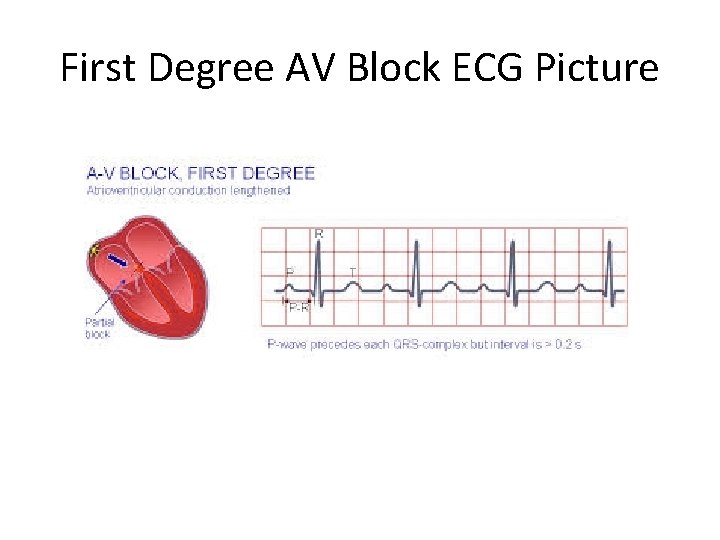 First Degree AV Block ECG Picture 