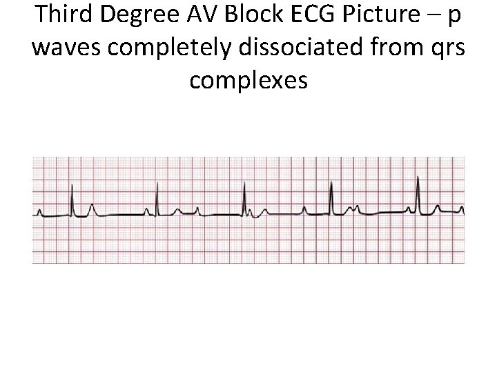 Third Degree AV Block ECG Picture – p waves completely dissociated from qrs complexes