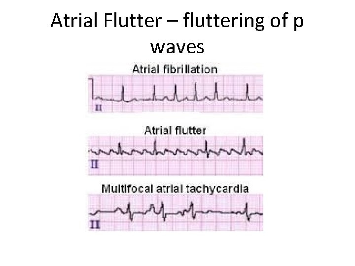 Atrial Flutter – fluttering of p waves 