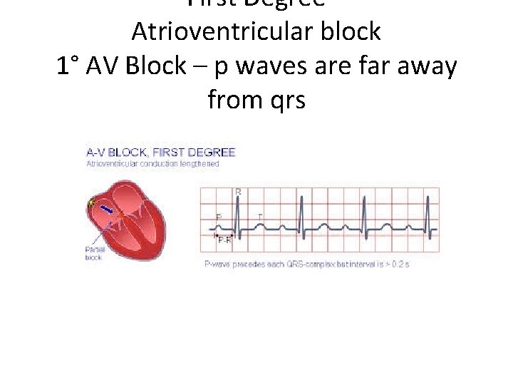 First Degree Atrioventricular block 1° AV Block – p waves are far away from