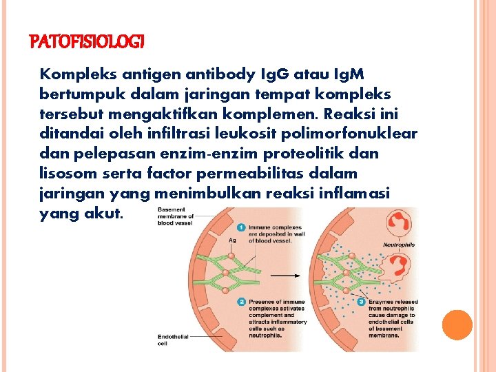 PATOFISIOLOGI Kompleks antigen antibody Ig. G atau Ig. M bertumpuk dalam jaringan tempat kompleks