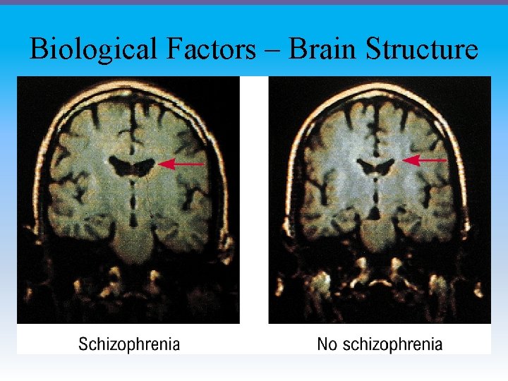 Biological Factors – Brain Structure 