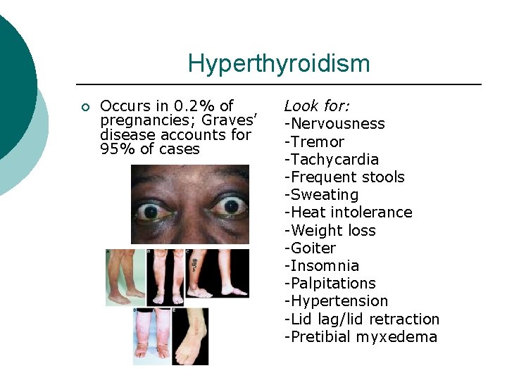 Hyperthyroidism ¡ Occurs in 0. 2% of pregnancies; Graves’ disease accounts for 95% of Hyperthyroidism ¡ Occurs in 0. 2% of pregnancies; Graves’ disease accounts for 95% of