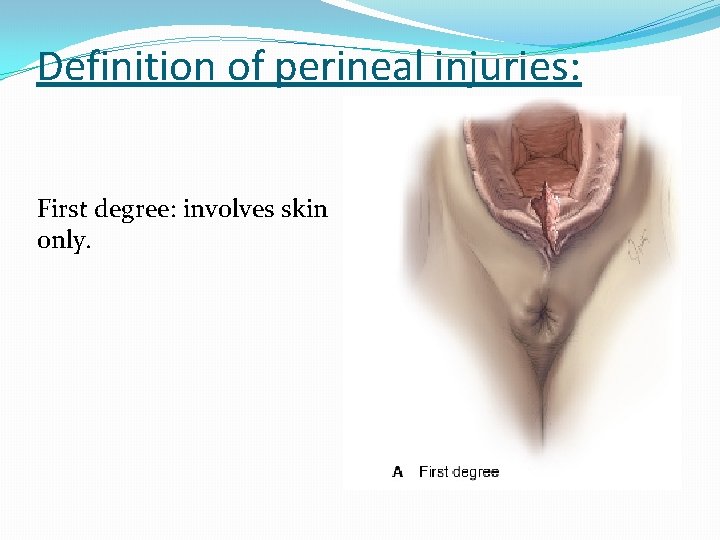 Definition of perineal injuries: First degree: involves skin only. 