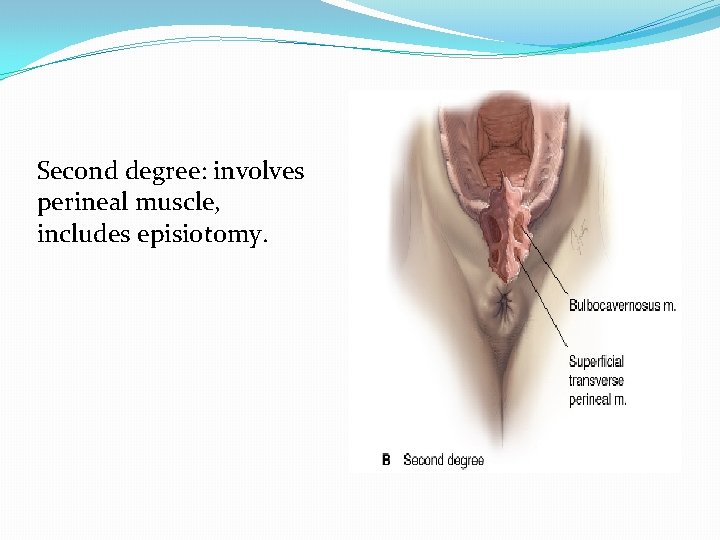 Second degree: involves perineal muscle, includes episiotomy. 