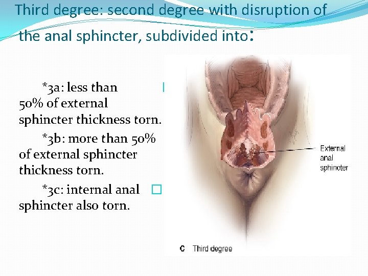 Third degree: second degree with disruption of the anal sphincter, subdivided into: *3 a: