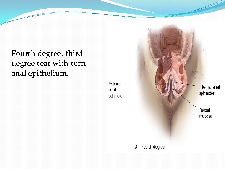 Fourth degree: third degree tear with torn anal epithelium. 