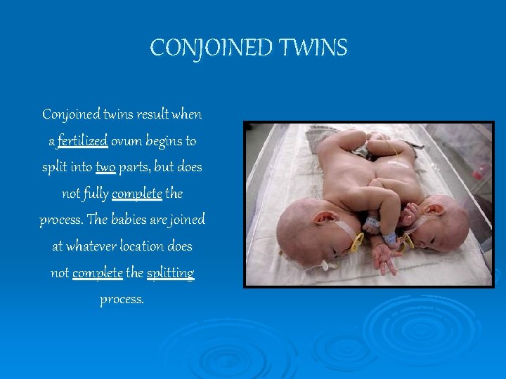 CONJOINED TWINS Conjoined twins result when a fertilized ovum begins to split into two