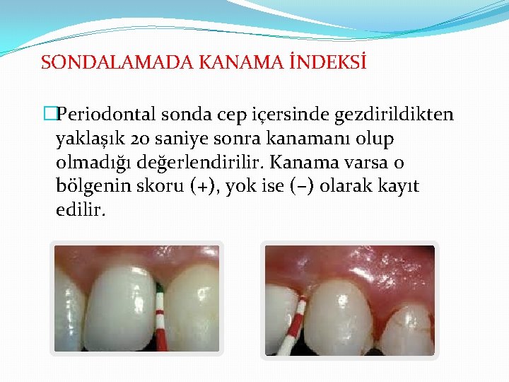 SONDALAMADA KANAMA İNDEKSİ �Periodontal sonda cep içersinde gezdirildikten yaklaşık 20 saniye sonra kanamanı olup SONDALAMADA KANAMA İNDEKSİ �Periodontal sonda cep içersinde gezdirildikten yaklaşık 20 saniye sonra kanamanı olup