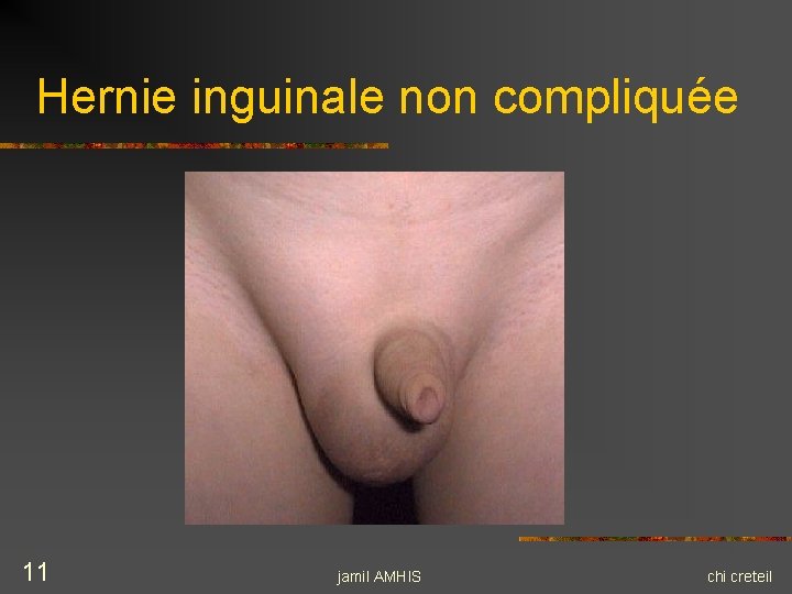 Hernie inguinale non compliquée 11 jamil AMHIS chi creteil Hernie inguinale non compliquée 11 jamil AMHIS chi creteil