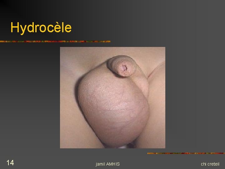 Hydrocèle 14 jamil AMHIS chi creteil Hydrocèle 14 jamil AMHIS chi creteil
