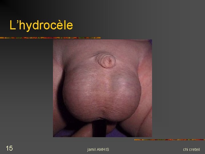L’hydrocèle 15 jamil AMHIS chi creteil L’hydrocèle 15 jamil AMHIS chi creteil