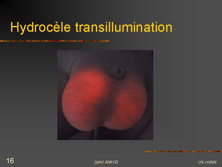 Hydrocèle transillumination 16 jamil AMHIS chi creteil Hydrocèle transillumination 16 jamil AMHIS chi creteil