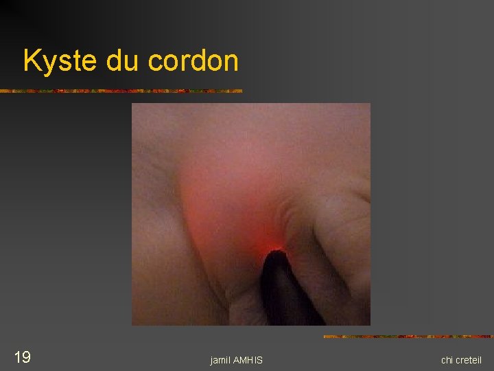 Kyste du cordon 19 jamil AMHIS chi creteil Kyste du cordon 19 jamil AMHIS chi creteil