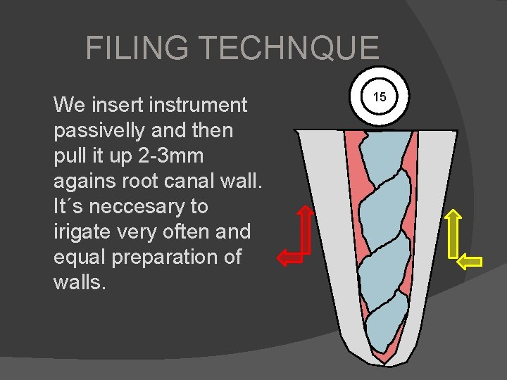 FILING TECHNQUE We insert instrument passivelly and then pull it up 2 -3 mm