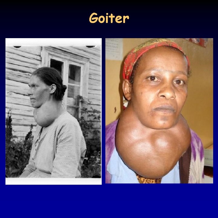 Goiter 