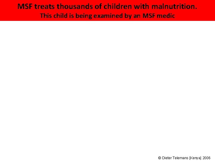 MSF treats thousands of children with malnutrition. This child is being examined by an MSF treats thousands of children with malnutrition. This child is being examined by an