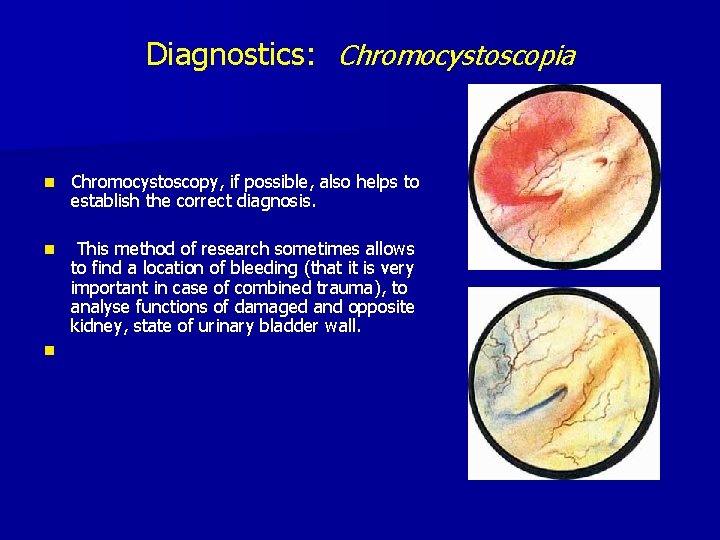 Diagnostics: Chromocystoscopia n Chromocystoscopy, if possible, also helps to establish the correct diagnosis. n